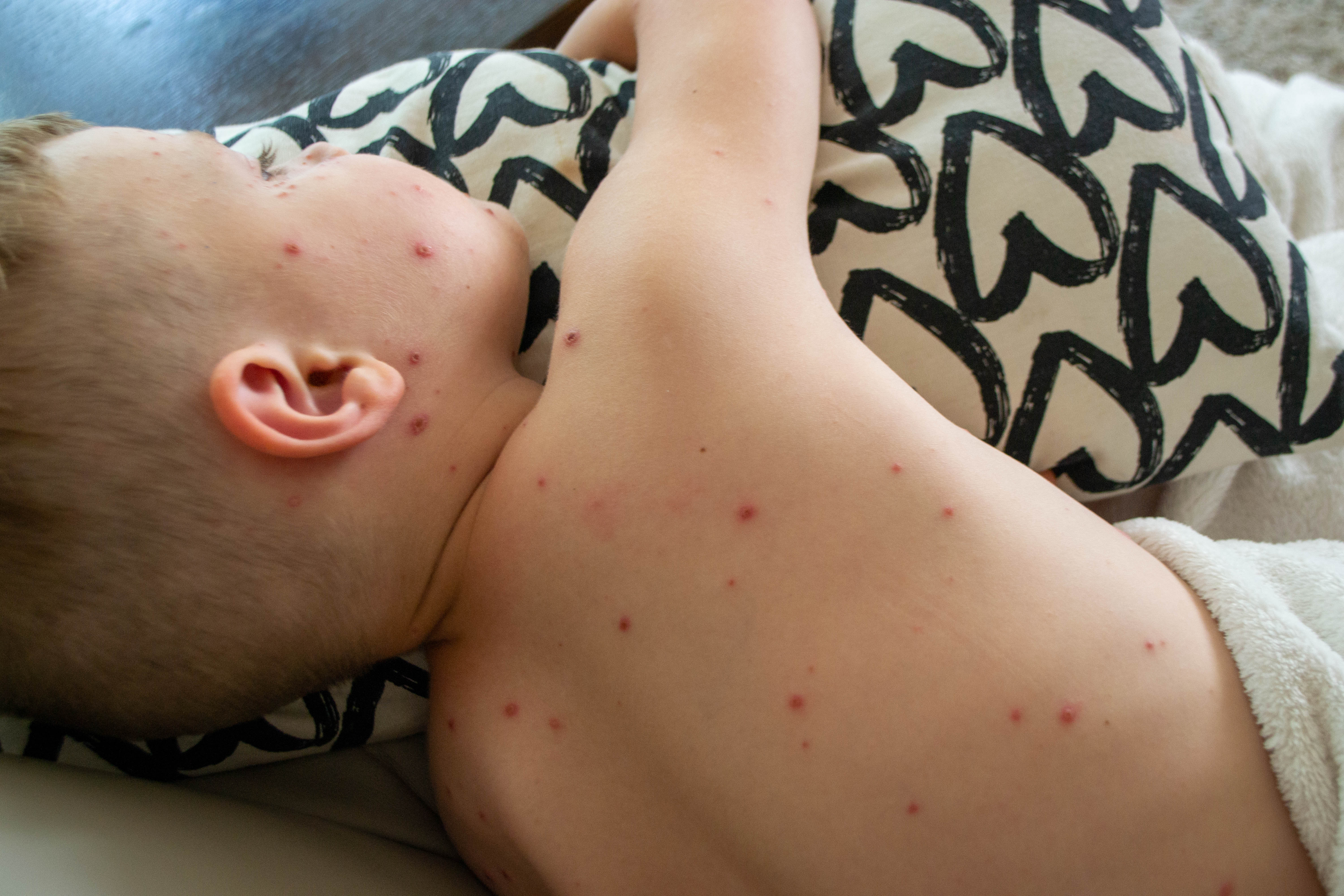 Outbreak Dynamics and Epidemiology of Chickenpox in Western India: A 9-Year Retrospective Study